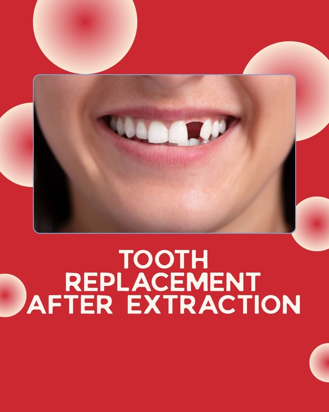 tooth-replacement-after-extraction