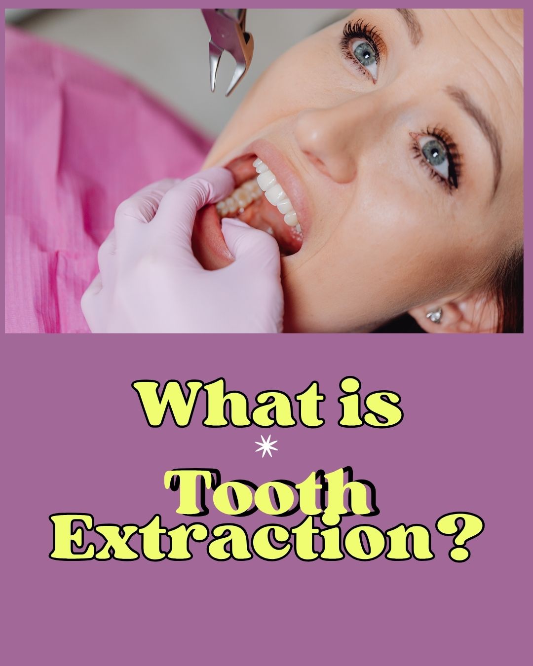 what-is-tooth-extraction